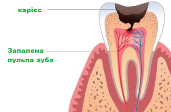 Зображення пульпіту на зубі