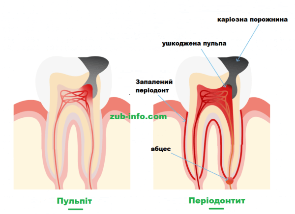 Картинка - Різниця між пульпітом та періодонтитом