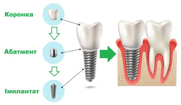 картинка Імплантація зубів