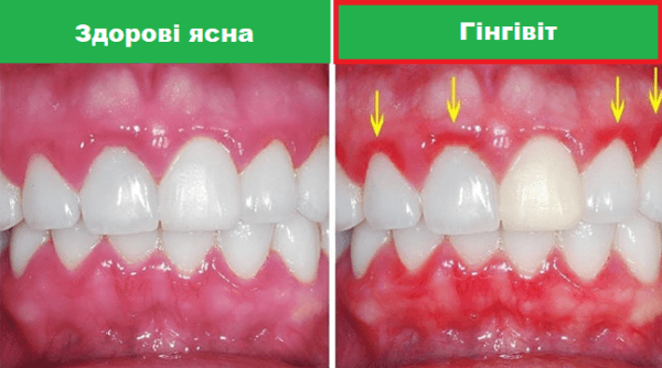 фото здорових ясен і з Гінгівітом