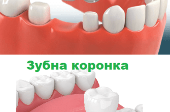 Картинка Зубний міст і зубна коронка